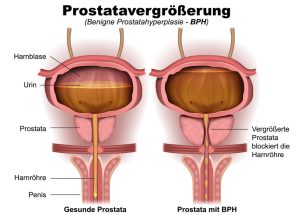 Prostatavergroesserung; Urheber: © bilderzwerg/fotolia